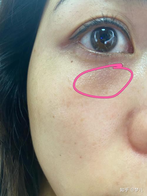 这是毛周角化吗?怎么治疗