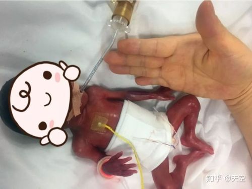 25周超早产儿590g620g双胎宝宝都平平安安