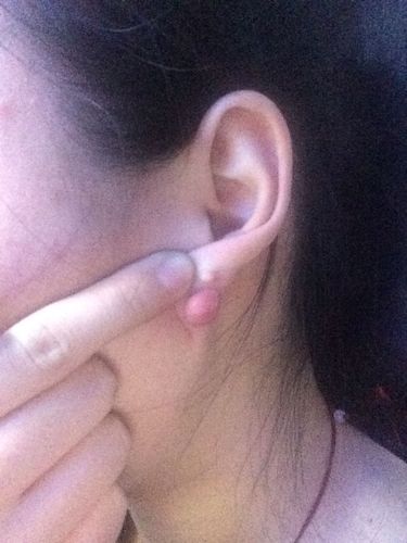 不戴耳钉之后耳朵后面长了个肉球"挺大的"而且耳洞也长死了"不痛不痒"