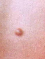 隆突性皮肤纤维肉瘤