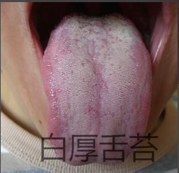 2 胃气上逆:恶心,呕吐呃逆,胁肋脘腹胀满或胃脘作痛,舌苔白厚.