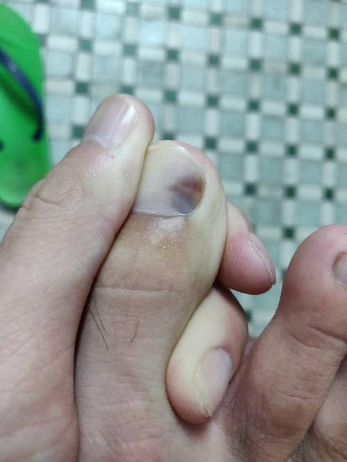 脚趾甲不知道什么时候变黑.应该有一段时间了.是什么问题?