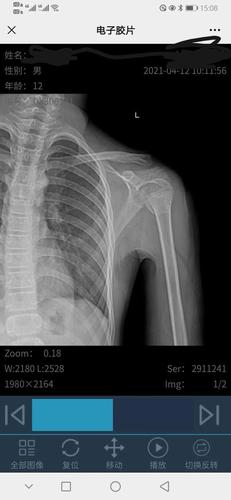 孩子摔伤,左肱骨近端骨折,是保守治疗还是动手术治疗好