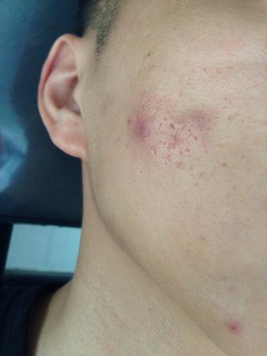 脸上老长暗疮,(有图),里面有脓和血,是虫子在里面