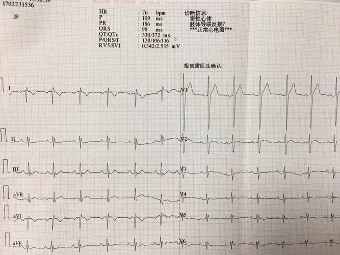 右位心心电图收集