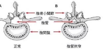 (正常椎管和椎管狭窄,图片源自网络)