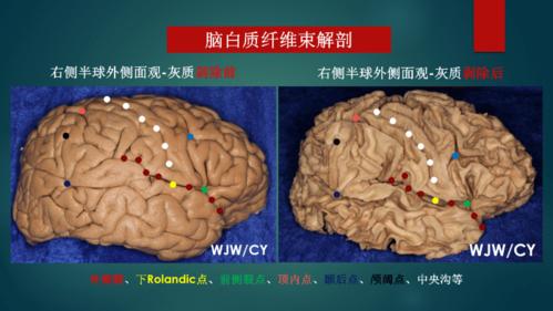 【实用解剖】脑白质纤维束解剖学习对年轻医生手术训练的启示