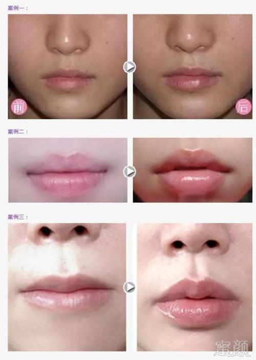 看完了这篇文章后,小编有几个问题想问问大家,大家有没有想过做完丰唇