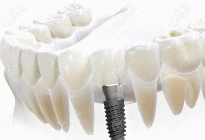 种植牙价格贵的和便宜的区别在哪里?难道越贵的使用寿命越长