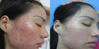 治疗痤疮的最好治疗方法