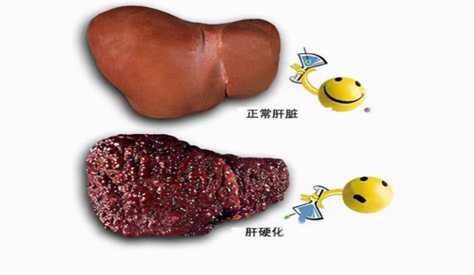 脾大不是肝硬化:认清脾大和肝硬化的关系,了解肝硬化脾大的危害