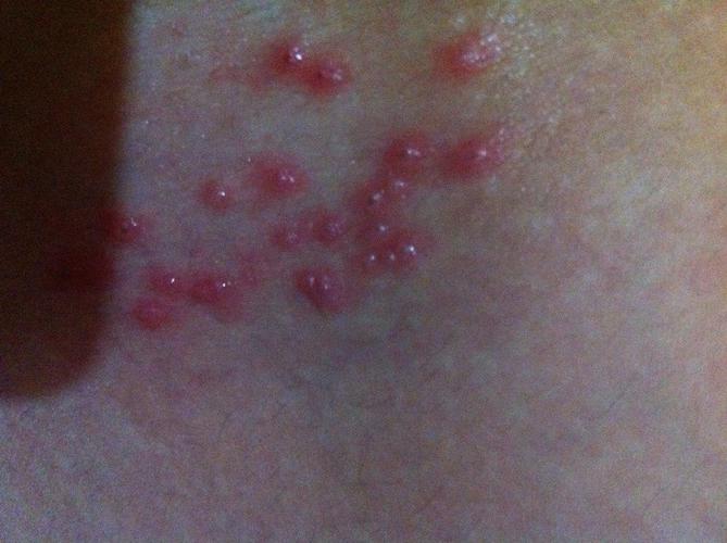 谁知道大腿根除长得这个是什么.