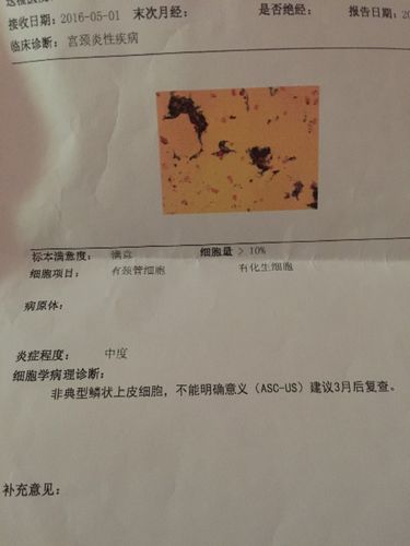 去体验说我宫颈糜烂中度 去医院做了检查hpv16高危亚型16 阳性 严重吗