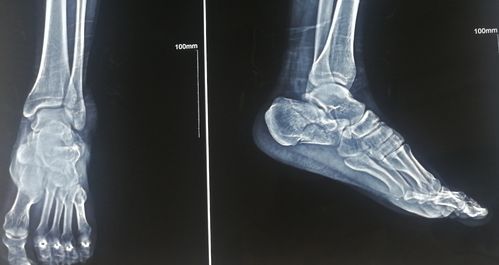 29岁跟骨骨折闭合撬拨复位内固定手术一例