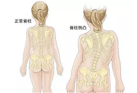 不容忽视的儿童脊柱侧弯