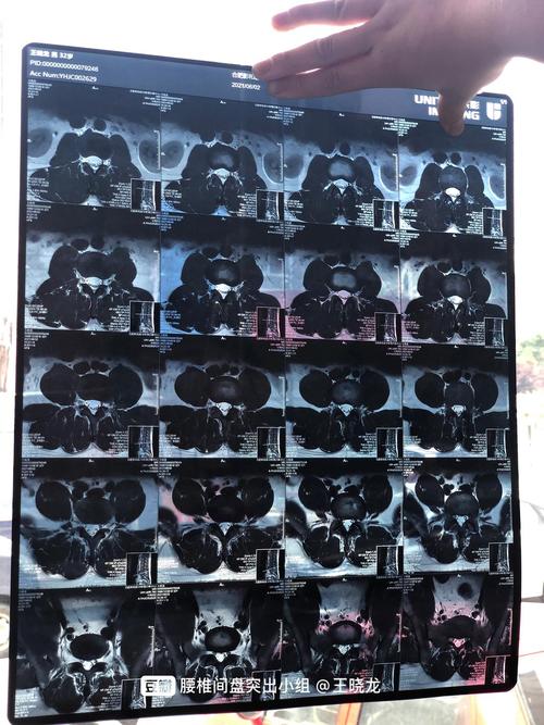 核磁共振片子,医生说轻度,不严重,哪个能看懂?有点怕