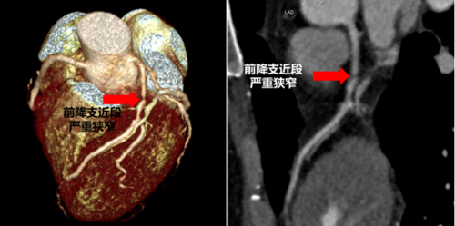 (图1,左前降支近段约95%狭窄)