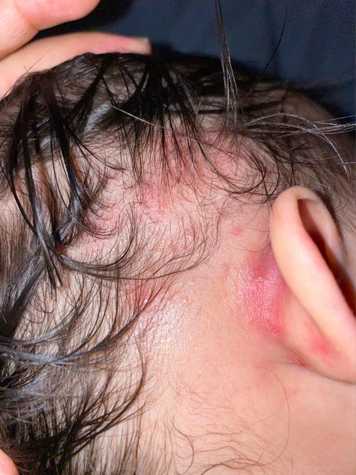 请问各位宝妈宝宝头皮长的这是湿疹吗?