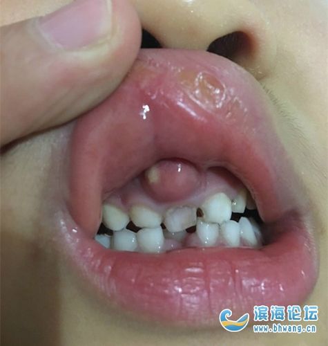 小朋友上牙龈长出了一个肉包,有懂的帮忙看