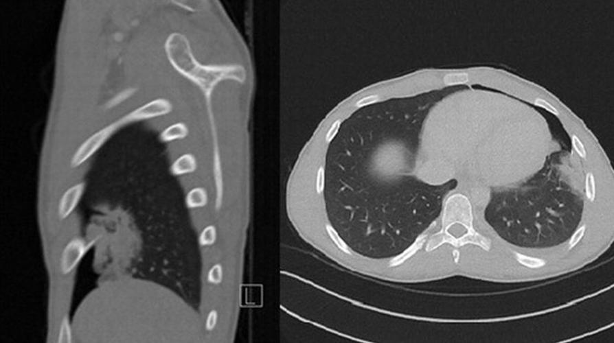胸部x线片示左侧心尖少量气胸,邻近胸膜粘连.