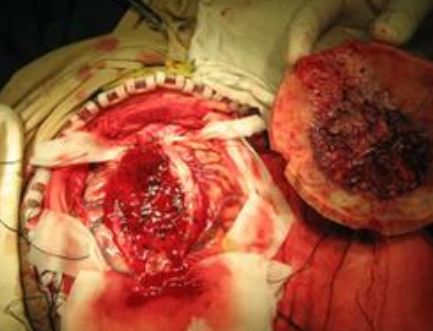 脑癌通过吃药能治愈吗