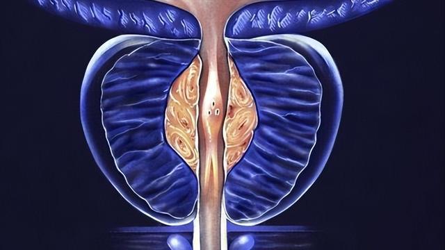 体检报告中的高频词前列腺钙化是什么对健康有影响吗