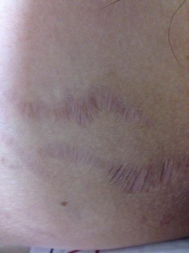 问:大腿内侧出现一条一条的.这是什么?严重不?怎么治疗?