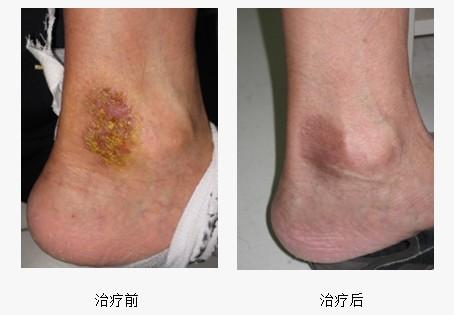 病例精选20:踝部湿疹