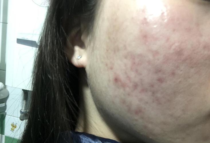 慎入慎入 针清了以后脸上全是红色痘印怎么办!