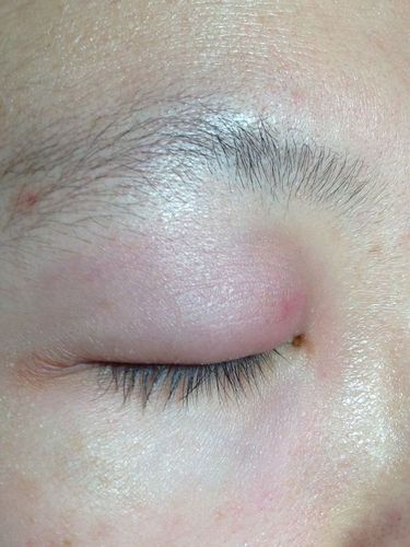 眼皮肿了怎么办?内有图.