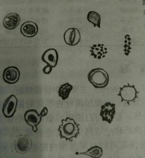 尿液异常红细胞