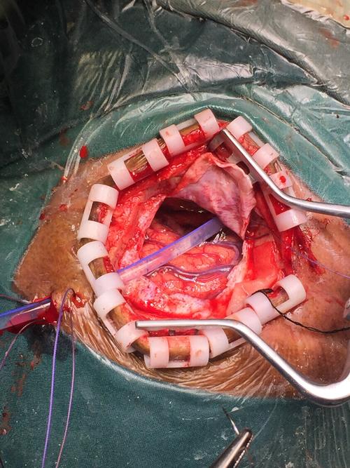 颅内肿瘤我们更精准