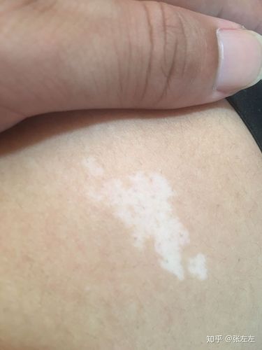 你见过什么特殊的胎记?