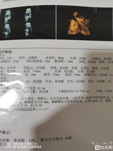 24周医生说胎儿横胎脐带绕颈一圈小了一个