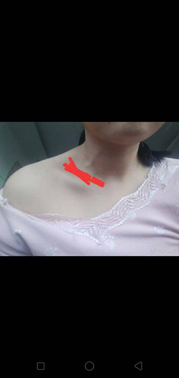 这个位置是锁骨上窝淋巴结吗