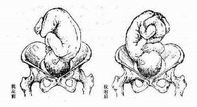 臀先露有六种胎位:左骶前(lsa) 左骶横(lst) 左骶