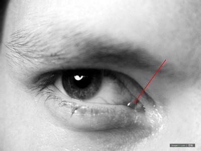 失眠,早晨起床眼角泪阜红肿,如图,这是怎么了,现在很着急