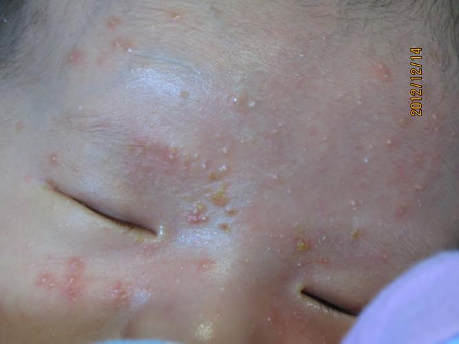 新生儿面部起小疙瘩也不像是湿疹的问题!这几天满脸都