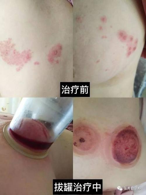 治疗| 中医刮痧拔罐巧治疼痛难忍的带状疱疹