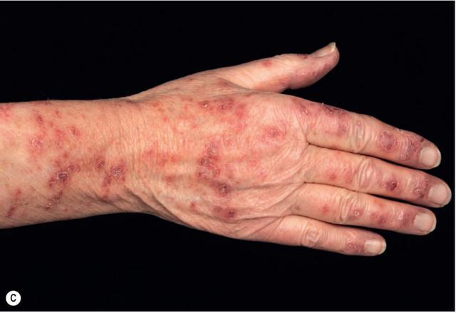 亚急性皮肤型红斑狼疮