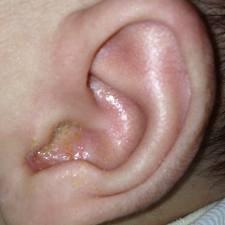 阿拉丁aladin 馆藏分类"油耳"又名湿型耵聍,湿耳朵