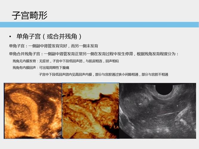 子宫畸形超声诊断标准及思路ppt