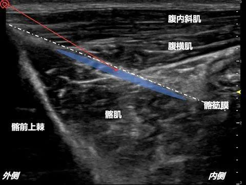 图16:腹股沟韧带上髂筋膜阻滞解剖结构标注图
