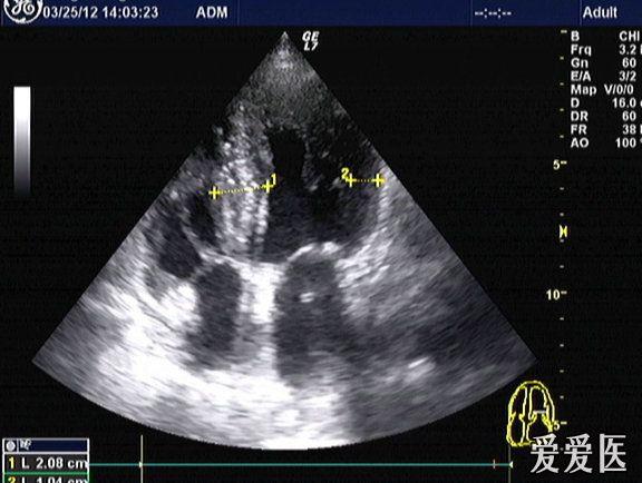 肥厚型心肌病?梗阻还是非梗阻?
