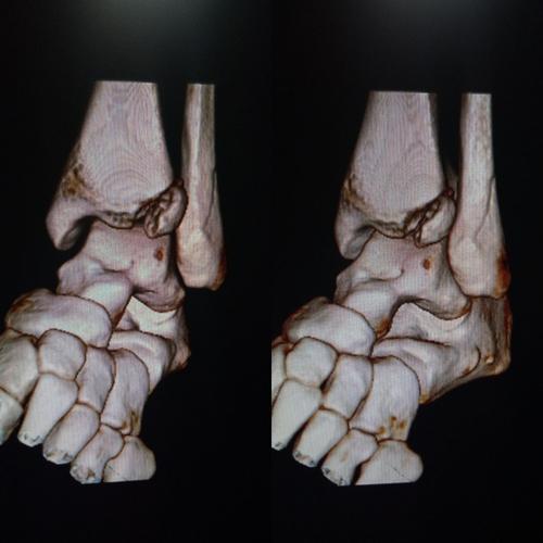 ct三维重建图像显示胫骨远端骨块旋转分离移位