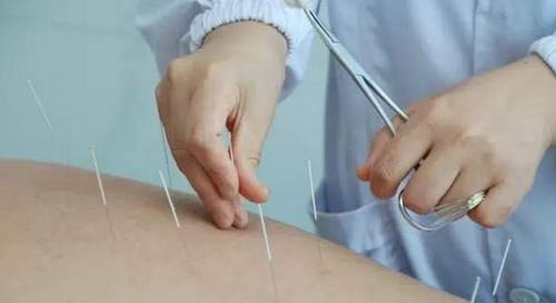 针灸减肥有副作用吗