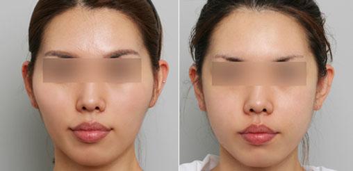 微创整形科 / 面部整形 / 颧部整形_广东省第二人民