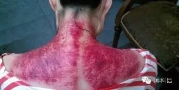 清医家郭志邃于1675年所撰《痧胀玉衡》是关于痧症和刮痧的专著.