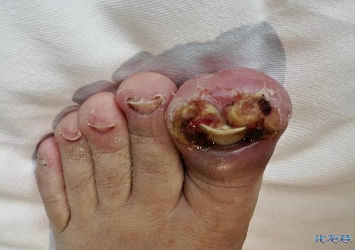 慎点!有非常严重的甲沟炎,脚已经烂成这样了还有