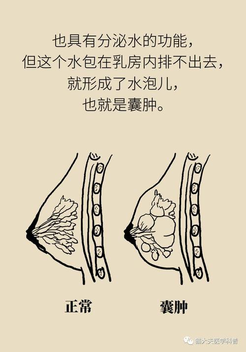 乳腺囊肿不是气出来的,真相是你老了